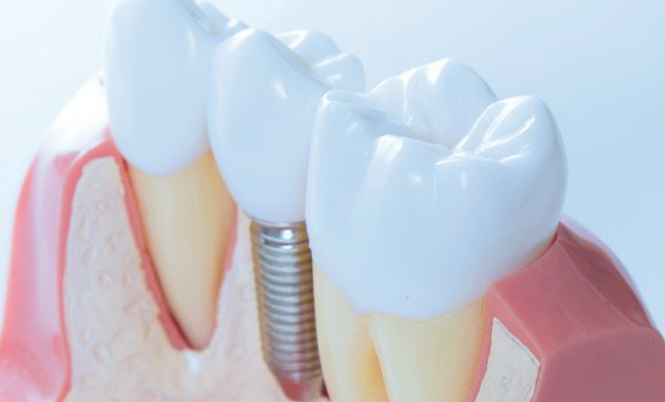IMPLANTE DENTAL